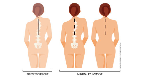 minimally invasive scoliosis surgery versus traditional scoliosis surgery texas